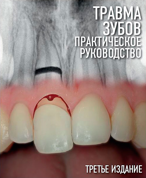 «Травма зубов. Практическое руководство» Йенс О. Андреасен